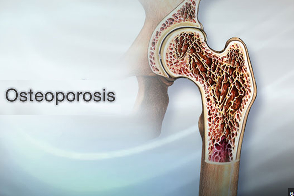 مهم ترین عادتی که باید برای جلوگیری از پوکی استخوان در سالمندی ترک کنید